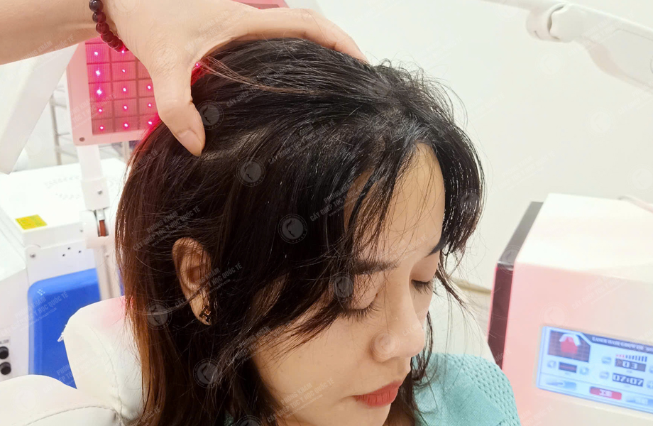 Phạm Thị Thu Trang - Cấy tóc đường chữ M 6