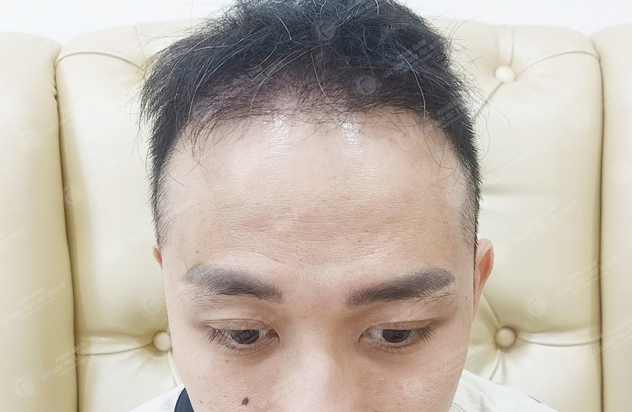 Lý Văn Thế - Cấy tóc đường chữ M 6