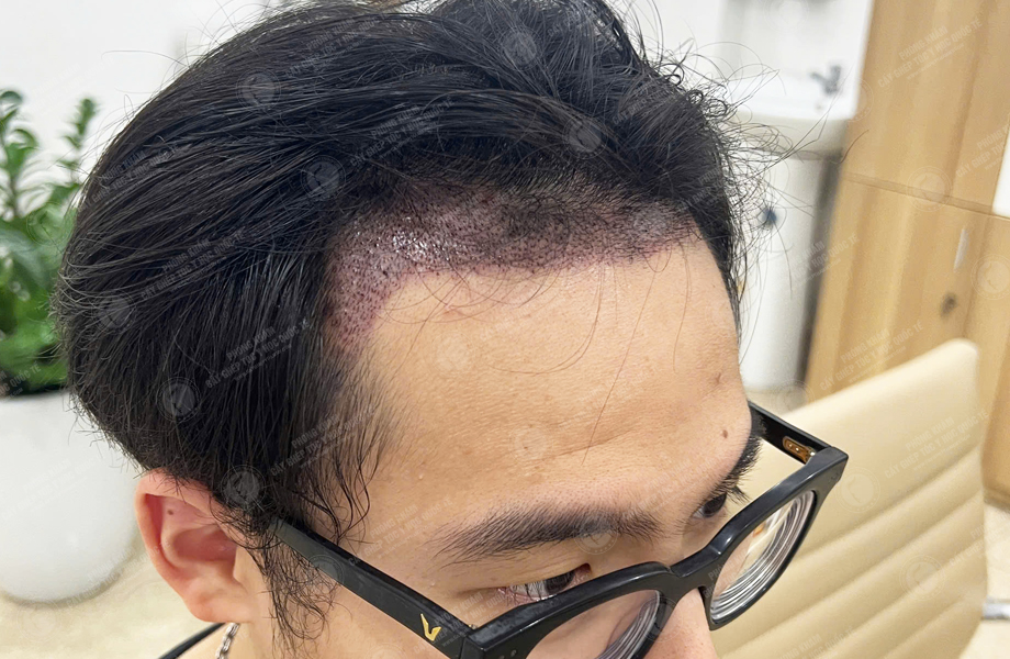 Hoàng Văn Tài - Cấy tóc đường chữ M 6