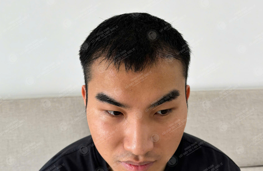 Nguyễn Đức Hùng - Cấy tóc đường chữ M 6