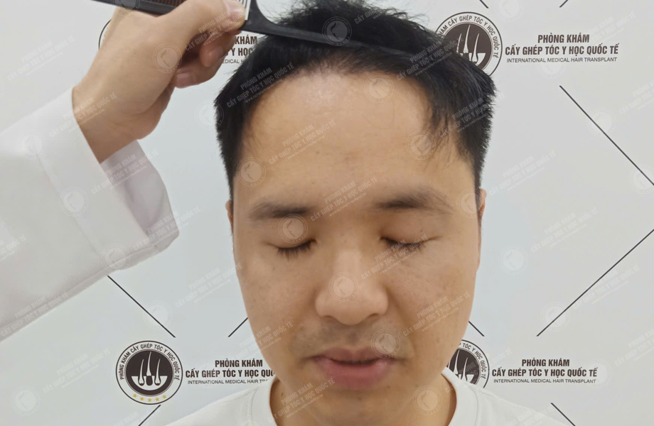 Phạm Quang Nhật - Cấy tóc đường chữ M 6