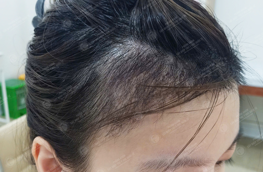 Nguyễn Thanh Tâm - Cấy tóc đường chữ M 6