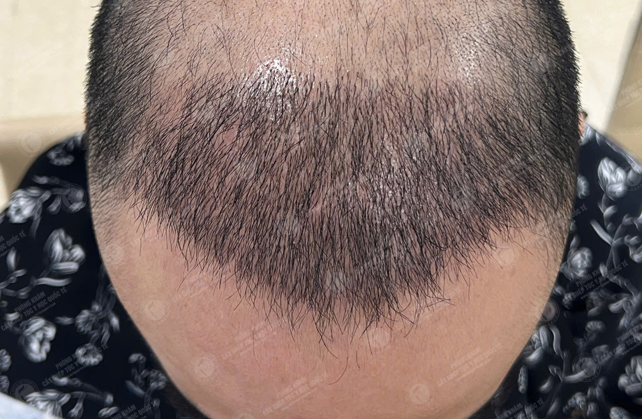 Ngô Văn Tâm - Cấy tóc đường chữ M 6