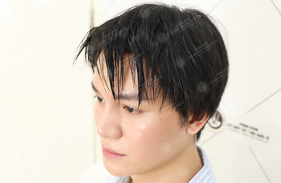Cường Jin - Cấy tóc đường chữ M 6