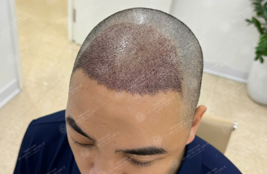 Trần Văn Nam - Cấy tóc đường chữ M 6