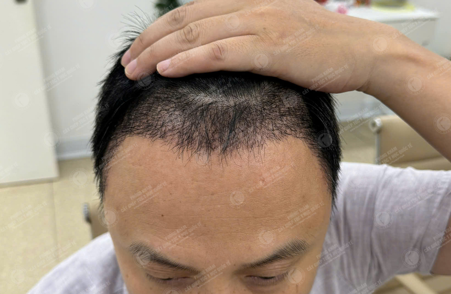 Trần Xuân Đông - Cấy tóc đường chữ M 6