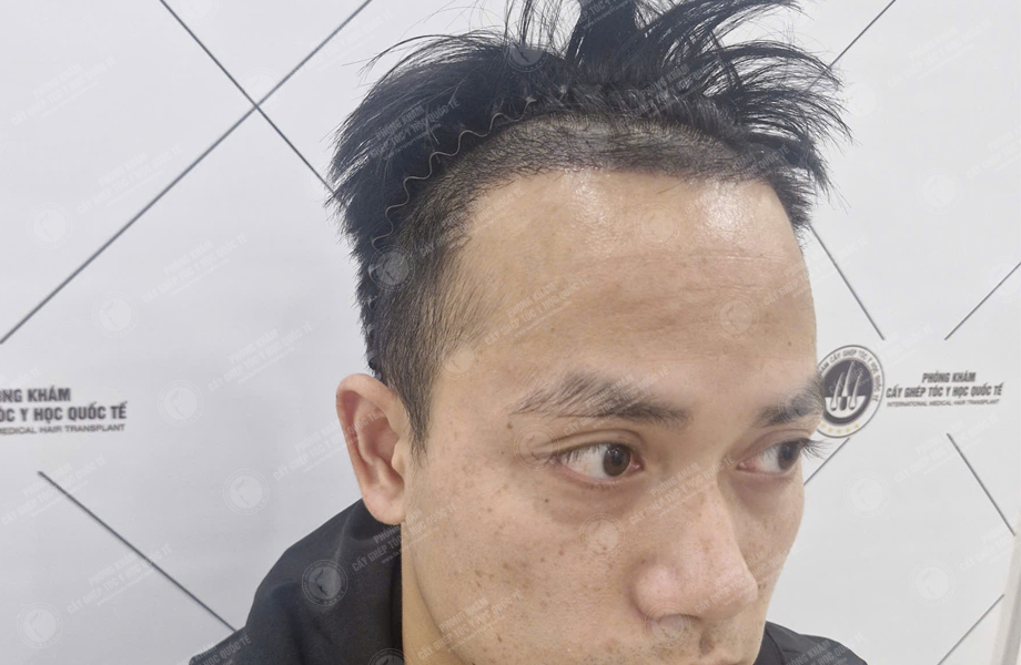 Nguyễn Huy Hùng - Cấy tóc đường chữ M 6