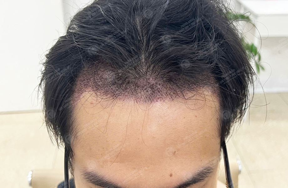 Hoàng Văn Tài - Cấy tóc đường chữ M 7