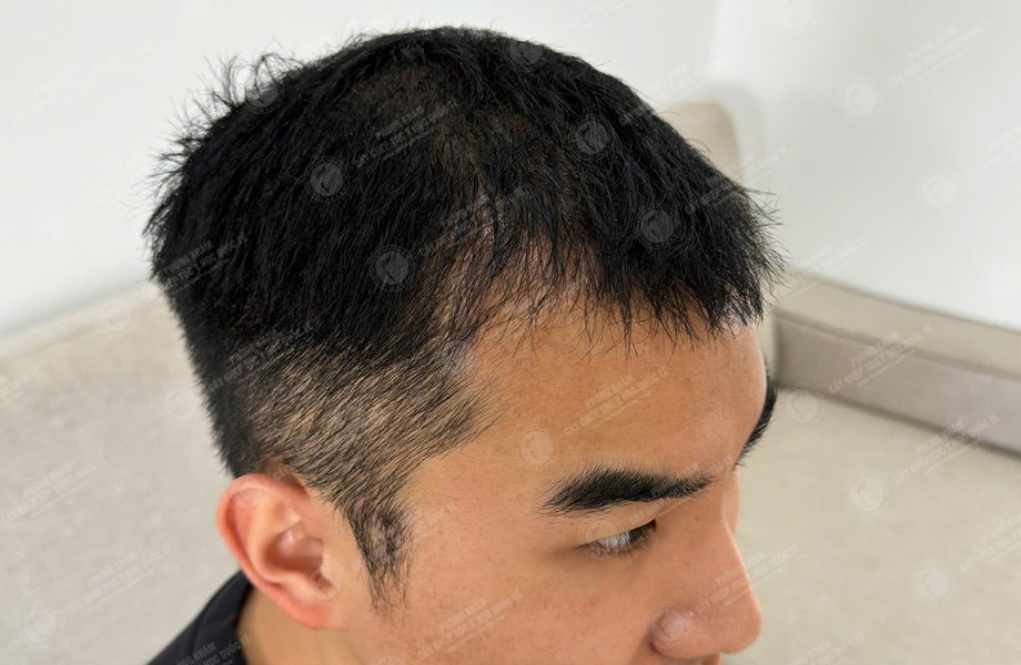 Nguyễn Đức Hùng - Cấy tóc đường chữ M 7