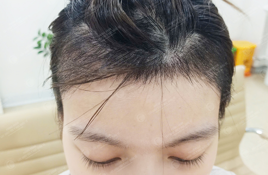 Nguyễn Thanh Tâm - Cấy tóc đường chữ M 7