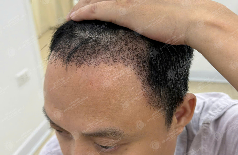 Trần Xuân Đông - Cấy tóc đường chữ M 7