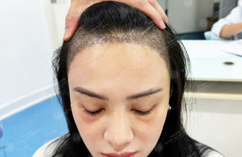 Lê Hồng Nhung - Cấy tóc đường chữ M 7