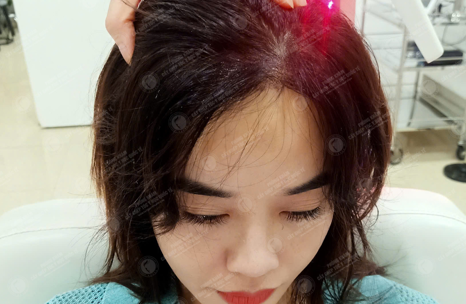 Phạm Thị Thu Trang - Cấy tóc đường chữ M 7