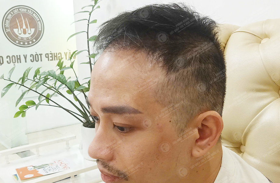 Lý Văn Thế - Cấy tóc đường chữ M 7