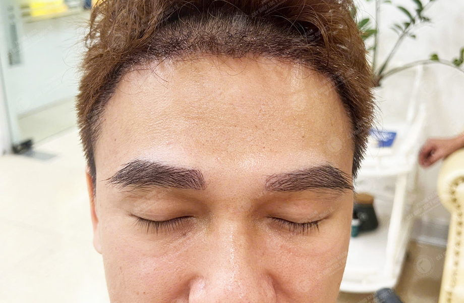 Đoàn Văn Sơn - Cấy lông mày 7