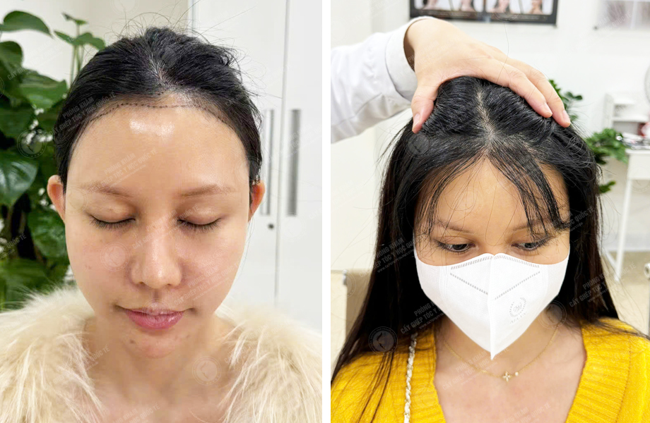  Lê Ngọc Hân - Cấy tóc đường chữ M 1