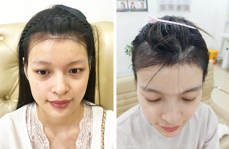  Nguyễn Thanh Tâm - Cấy tóc đường chữ M 1