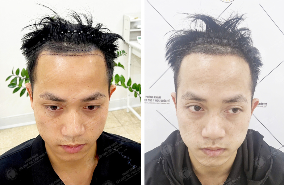  Nguyễn Huy Hùng - Cấy tóc tự thân 1