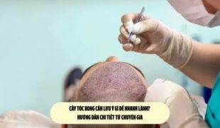Cấy tóc xong cần lưu ý gì để nhanh lành? Hướng dẫn chi tiết từ chuyên gia
