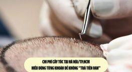 Chi phí cấy tóc tại Hà Nội/TP.HCM: Hiểu đúng từng khoản để không “trả tiền oan”