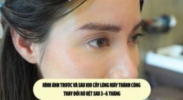 Hình ảnh trước và sau khi cấy lông mày thành công: Thay đổi rõ rệt sau 3–6 tháng