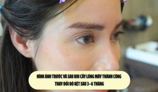 Hình ảnh trước và sau khi cấy lông mày thành công: Thay đổi rõ rệt sau 3–6 tháng