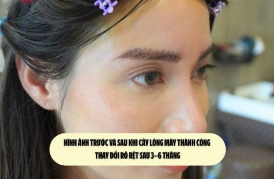 Hình ảnh trước và sau khi cấy lông mày thành công: Thay đổi rõ rệt sau 3–6 tháng