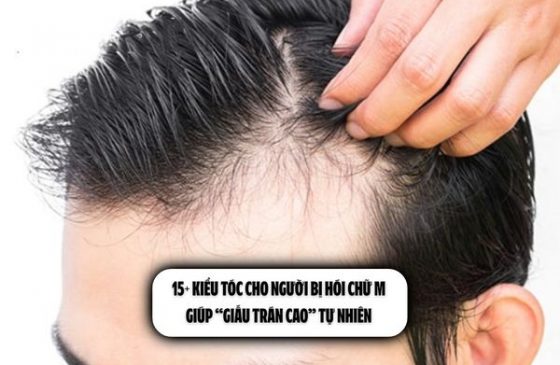 15+ Kiểu tóc cho người bị hói chữ M giúp “giấu trán cao” tự nhiên 