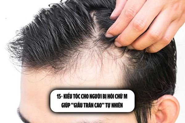 15+ Kiểu tóc cho người bị hói chữ M giúp “giấu trán cao” tự nhiên 