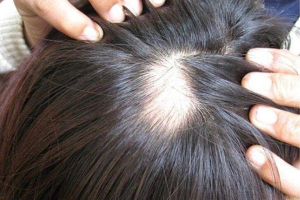 Nhổ tóc có mọc lại được không hay sẽ gây hói vĩnh viễn?