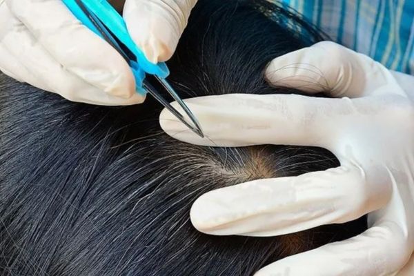 Nhổ tóc có mọc lại được không hay sẽ gây hói vĩnh viễn?