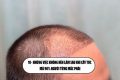 10+ Những việc không nên làm sau khi cấy tóc mà 90% người từng mắc phải