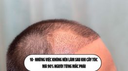 10+ Những việc không nên làm sau khi cấy tóc mà 90% người từng mắc phải