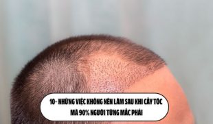 10+ Những việc không nên làm sau khi cấy tóc mà 90% người từng mắc phải