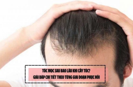 Tóc mọc sau bao lâu khi cấy tóc? Giải đáp chi tiết theo từng giai đoạn phục hồi