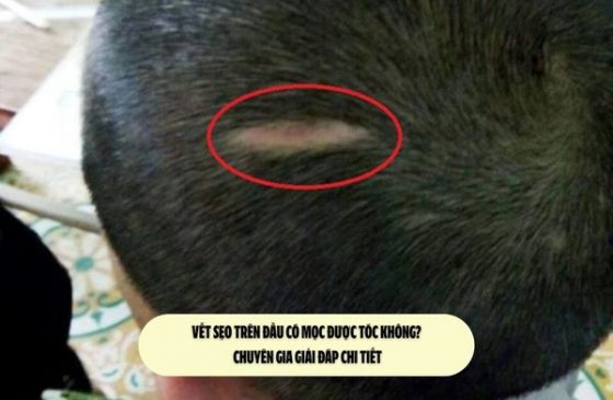 Vết sẹo trên đầu có mọc được tóc không? Chuyên gia giải đáp chi tiết