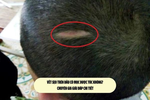 Vết sẹo trên đầu có mọc được tóc không? Chuyên gia giải đáp chi tiết
