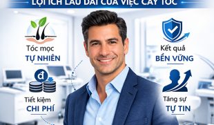 7 Lợi ích lâu dài của việc cấy tóc không phải ai cũng biết