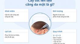 Cấy tóc lên sẹo căng da mặt là gì? Quy trình, chi phí và hiệu quả thực tế