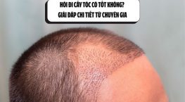 Hói đi cấy tóc có tốt không? Giải đáp chi tiết từ chuyên gia