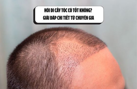 Hói đi cấy tóc có tốt không? Giải đáp chi tiết từ chuyên gia