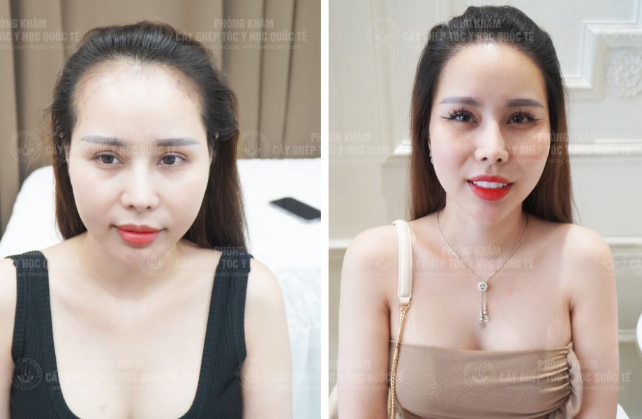  Nguyễn Nguyệt Nhi - Điều chỉnh đường chân tóc 1