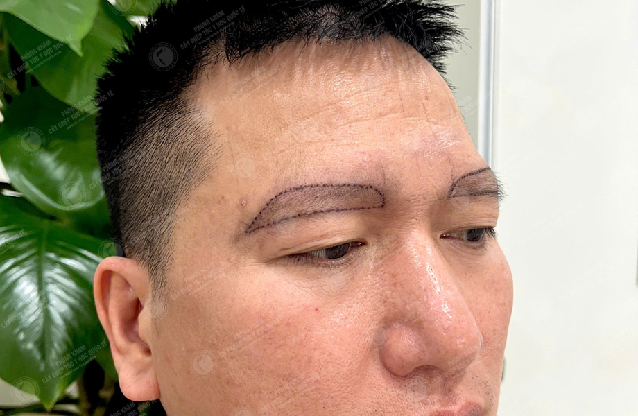 Đỗ Thanh Tùng - Cấy lông mày 2
