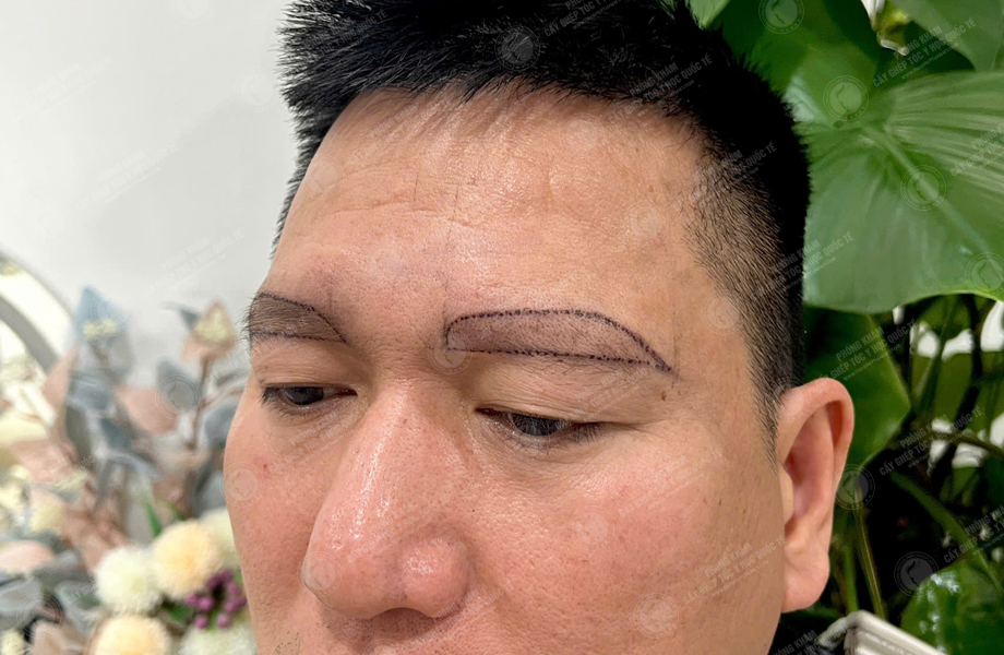 Đỗ Thanh Tùng - Cấy lông mày 3