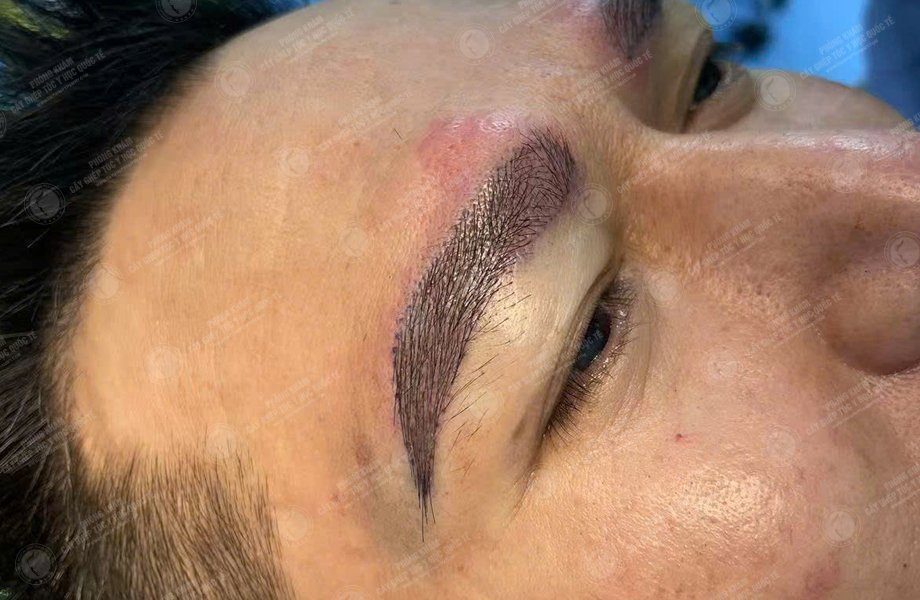 Đỗ Thanh Tùng - Cấy lông mày 5