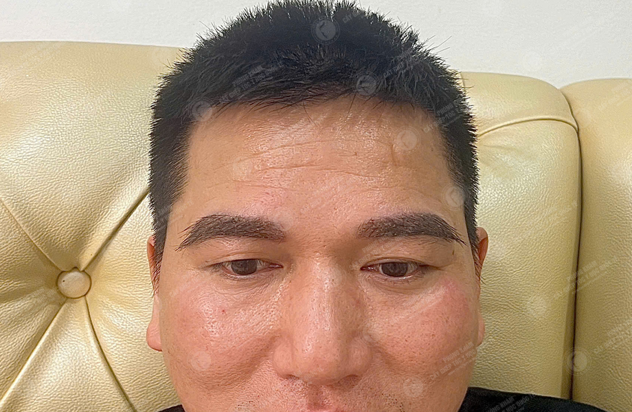 Đỗ Thanh Tùng - Cấy lông mày 6