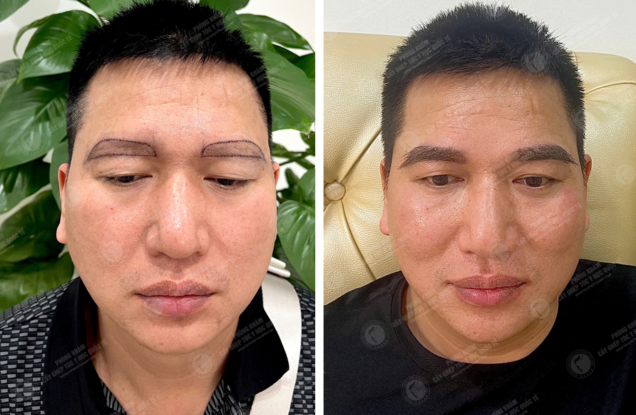 Đỗ Thanh Tùng - Cấy lông mày 1