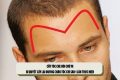 Cấy tóc che hói chữ M: Bí quyết lấy lại đường chân tóc chỉ sau 1 lần thực hiện