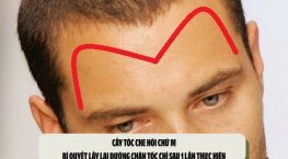 Cấy tóc che hói chữ M: Bí quyết lấy lại đường chân tóc chỉ sau 1 lần thực hiện