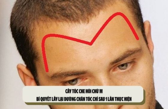 Cấy tóc che hói chữ M: Bí quyết lấy lại đường chân tóc chỉ sau 1 lần thực hiện